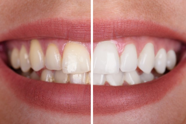 Options to Whiten up your Smile in The Woodlands & Spring